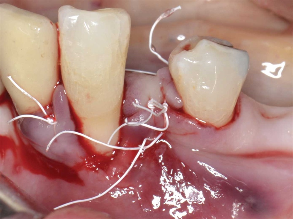 Tarquini_Periodontal intrabony defect
